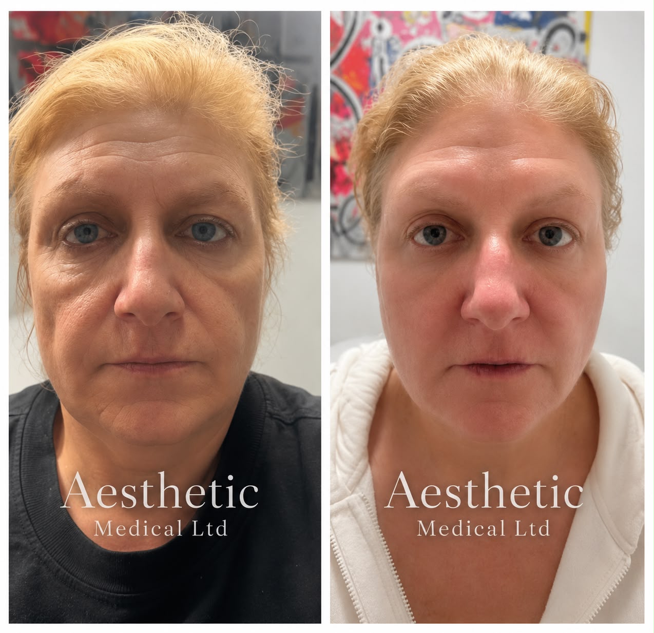 Facial Skin Rejuvenation