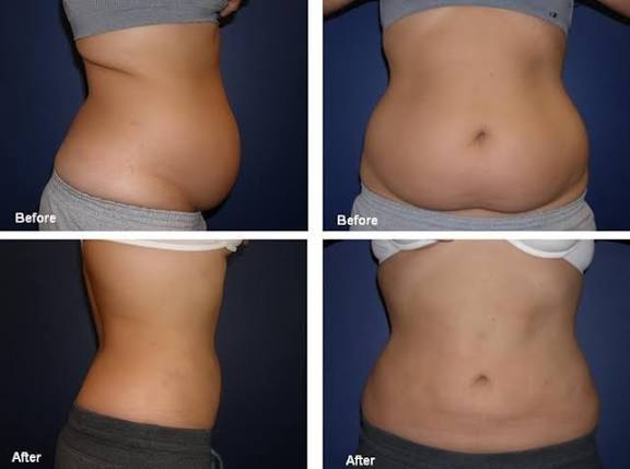 Endolift body contouring before and after — stomach area tightening and fat reduction