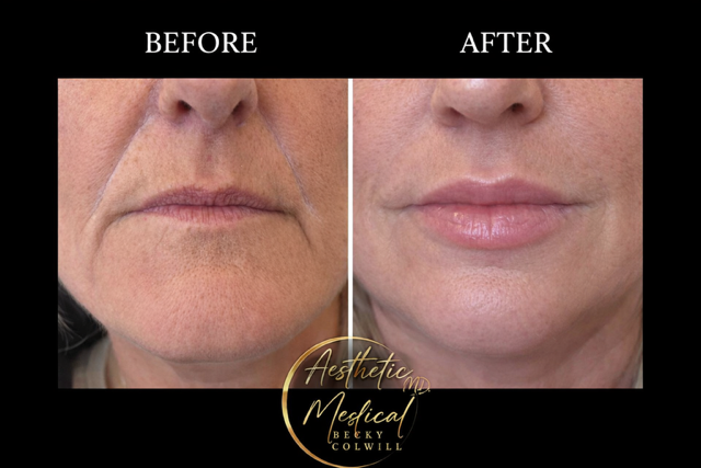 Nasolabial Fold Reduction