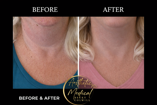 Neck Tightening & Smoothing